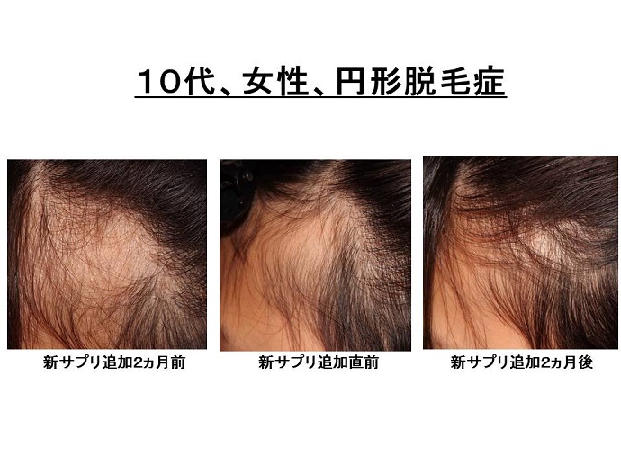 円形脱毛症　病院""